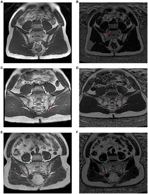 The diagnostic value of morphological features of fat deposition of sacroiliac joint steatosis in axial spondyloarthritis